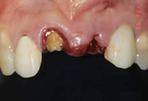 前歯の審美的治療と骨造成 前歯の治療 Before