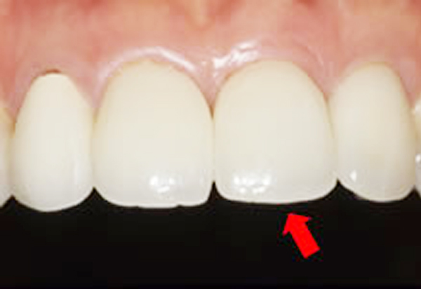 前歯の審美的治療と骨造成 前歯の治療 After