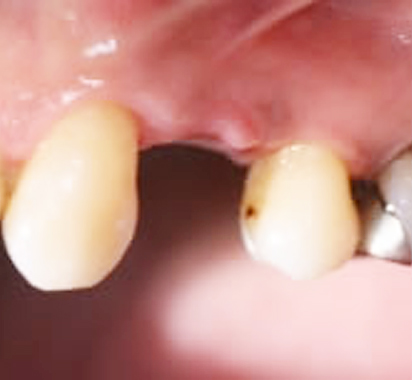 一歯欠損・ジルコニアの土台 ジルコニアアバットメントで治療