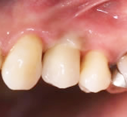 一歯欠損・ジルコニアの土台 ジルコニアアバットメントで治療