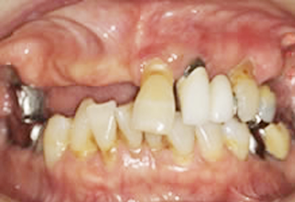 上顎全歯欠損・金属を使わない上部構造 金属を使わない人工の歯（上部構造）で治療 Before