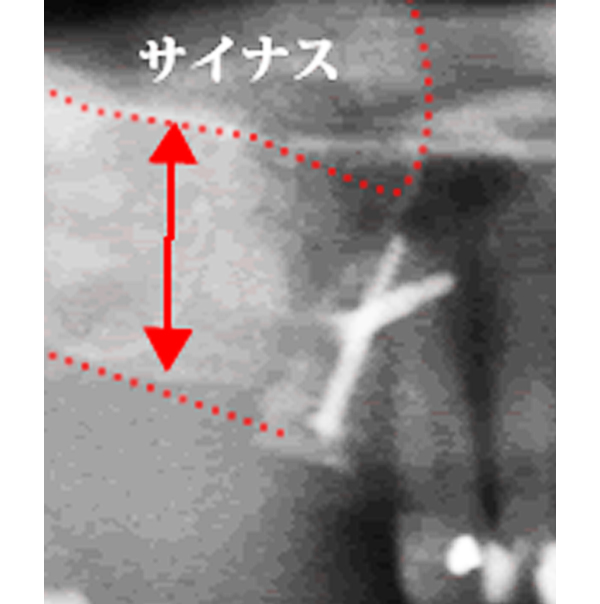 サイナスリフトによる骨造成 サイナスリフトによる骨造成 After