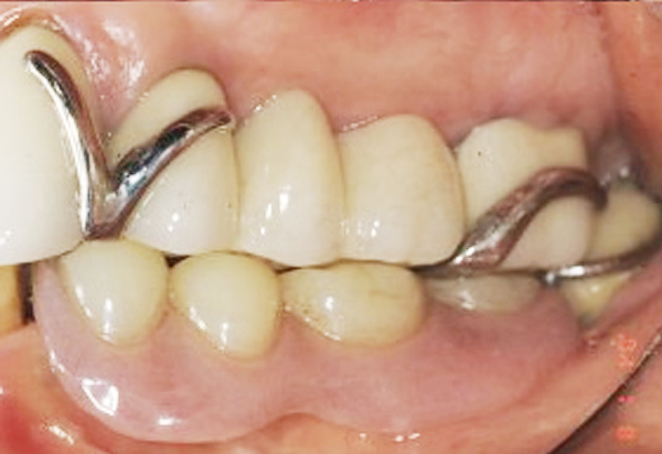 部分入れ歯からの開放 部分入れ歯から開放Before
