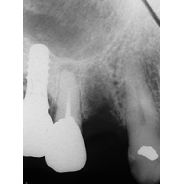 奥歯の1歯欠損（60代男性）右下６番欠損(右下の奥歯(大臼歯)１本の欠損)Before