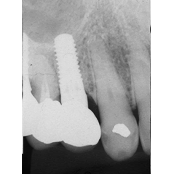 奥歯の1歯欠損（60代男性）右下６番欠損(右下の奥歯(大臼歯)１本の欠損)After