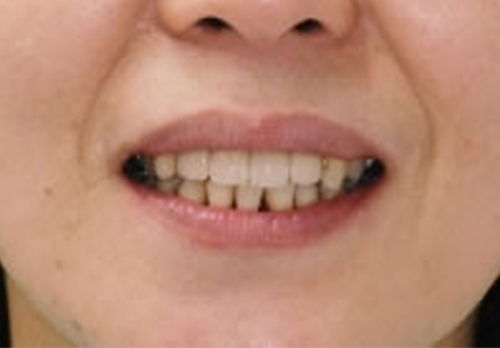 前歯の将来を考えた審美治療 前歯4本を審美面を重視した治療 After