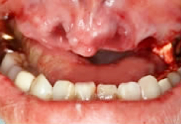 1日で噛めるインプラント・全歯欠損 上あご　全歯欠損 Before