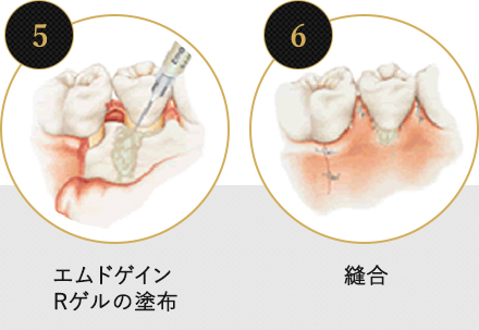 歯周外科手術とエムドゲインRゲルの塗布