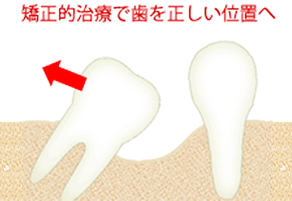 矯正的な治療で歯を正しい位置へ