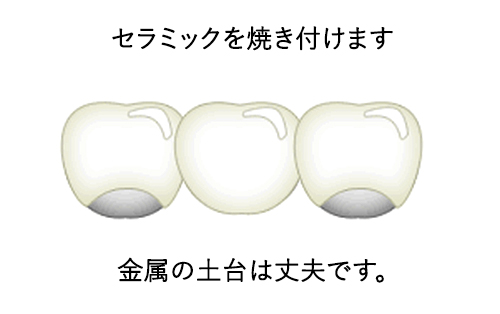 セラミックを焼き付けます金属の土台は丈夫です
