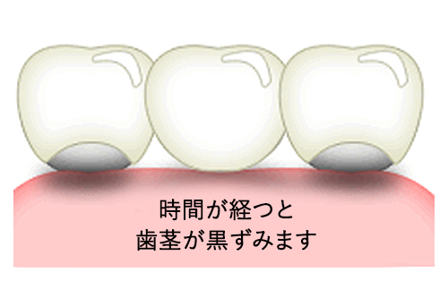 時間が経つと歯茎が黒ずみます