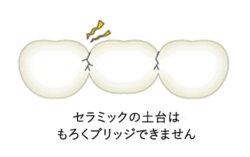 セラミックの土台はもろくブリッジできません