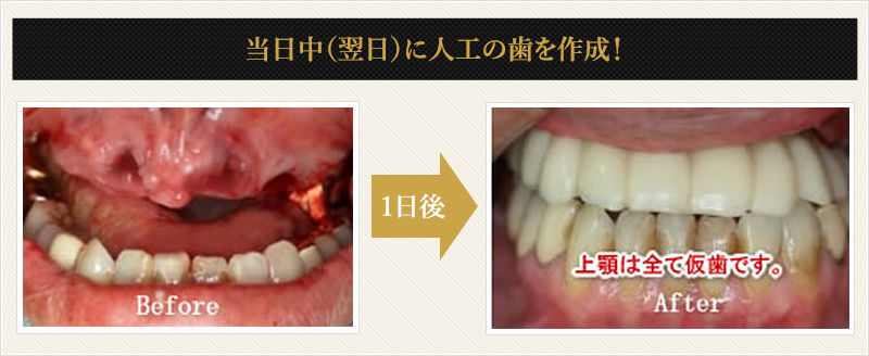 当日中（翌日）に人口の歯を作成！