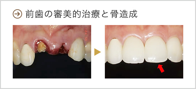 前歯の審美的治療と骨造成