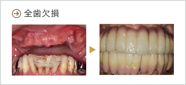 全歯欠損