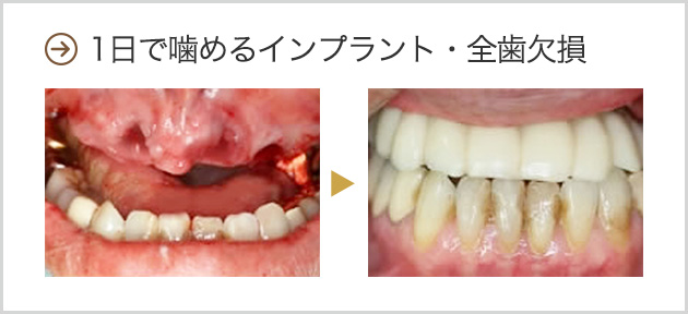 1日で噛めるインプラント・全歯欠損