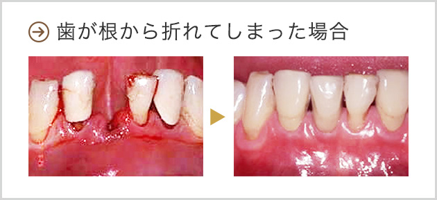 歯が根から折れてしまった場合