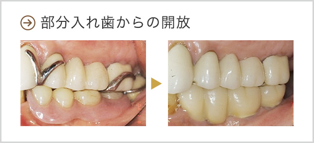 部分入れ歯からの開放