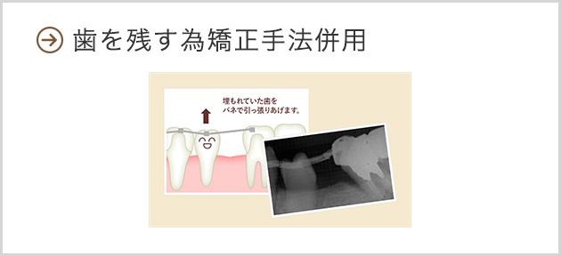 歯を残す為矯正手法併用