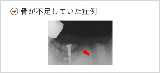 骨が不足していた症例