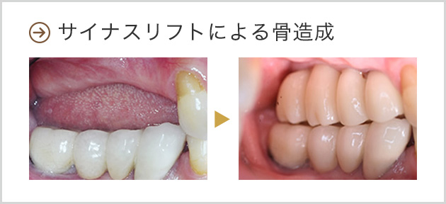 サイナスリフトによる骨造成