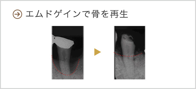エムドゲインで骨を再生
