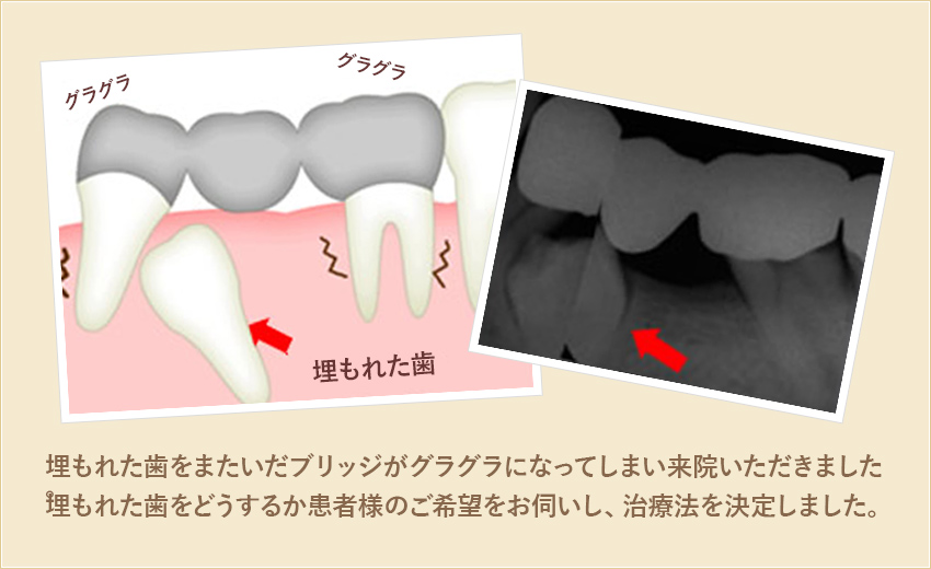埋もれた歯をまたいだブリッジがグラグラになってしまい来院いただきました。埋もれた歯をどうするか患者様のご希望かお伺いし、治療法を決定しました。