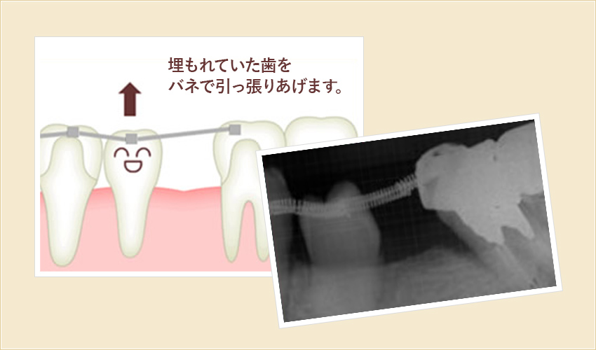 当院では「歯を残す選択」もご提案