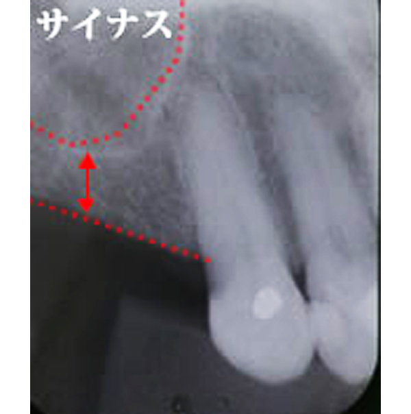 サイナスリフトによる骨造成 サイナスリフトによる骨造成 Before