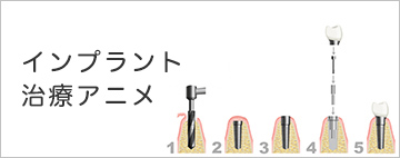 インプラント治療アニメ