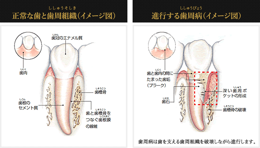 正常な歯と歯周組織(イメージ図)進行する歯周病(イメージ図)