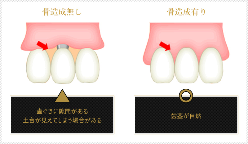 骨造成無し歯ぐきに隙間がある土台が見えてしまう場合がある　骨造成有り歯茎が自然