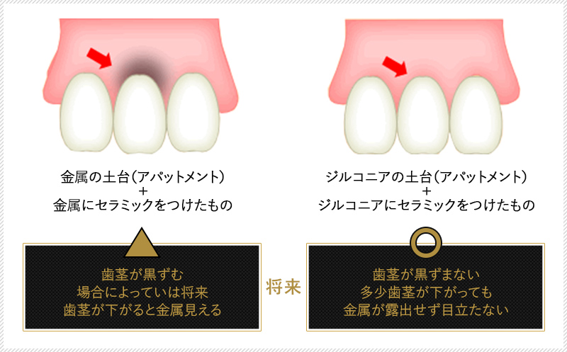 金属の土台（アパットメント）＋金属にセラミックをつけたもの歯茎が黒ずむ場合によっていは将来歯茎が下がると金属見える将来ジルコニアの土台（アパットメント）＋ジルコニアにセラミックをつけたもの歯茎が黒ずまない多少歯茎が下がっても金属が露出せず目立たない